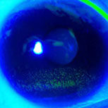 dryeye153x153