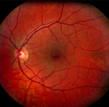 retinal
